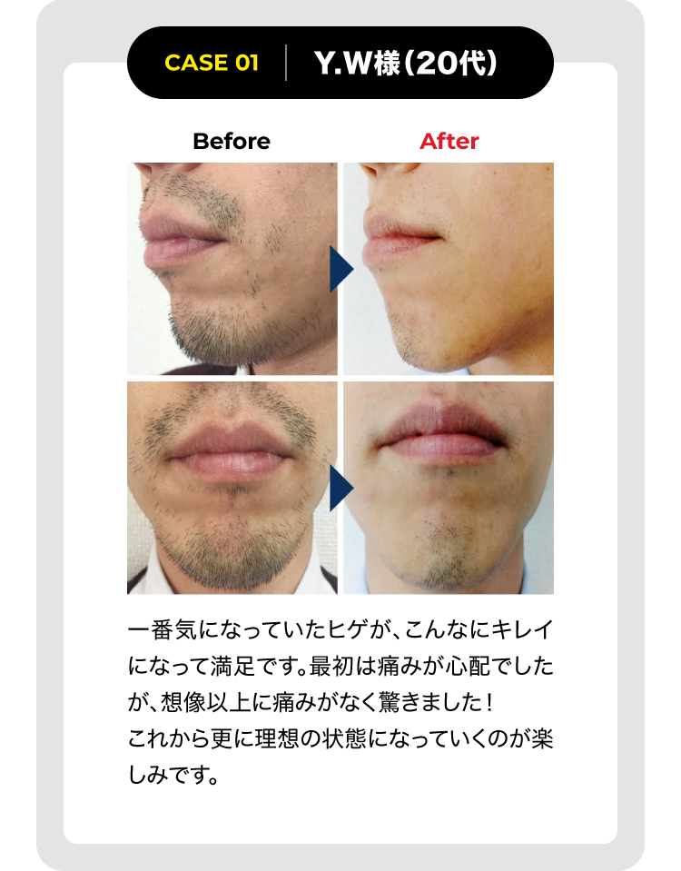 CASE1 Y.W様（20代）一番気になっていたヒゲが、こんなにキレイになって満足です。最初は痛みが心配でしたが、想像以上痛みがなく驚きました！これから更に理想の状態になっていくのが楽しみです。